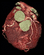心臓造影CT
