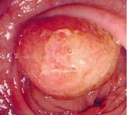 大腸ポリープ1
